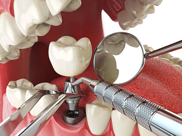 Best Broken or Chipped Tooth Repair in Sac City, IA